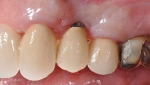Dental implant with minimal keratinized gingiva